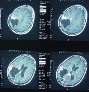 Susan Reynard's Brain X-Ray