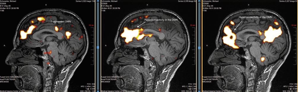 electromagnetic hypersensitivity brain scans