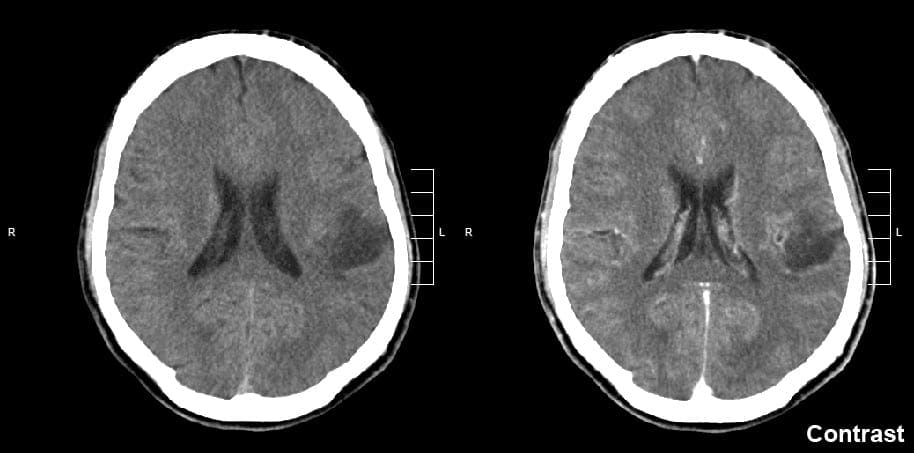 cell phone health risks - brain scan showing glioma