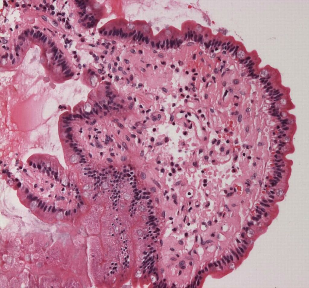 EMF-induced Amyloid production