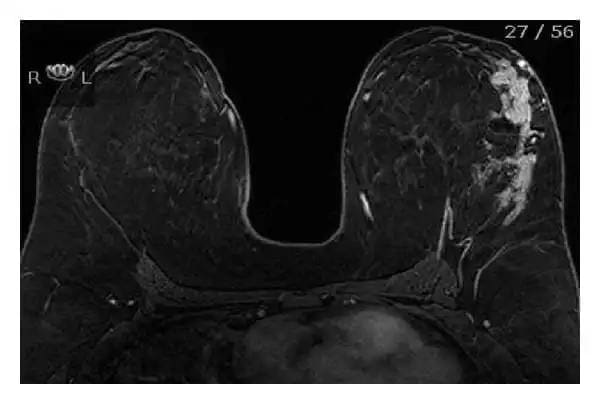 Mammogram of a 21-year-old patient who carried her cell phone in her bra on one side for several hours per day. 